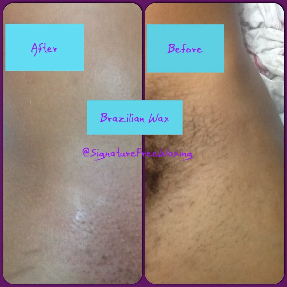 brazilian wax pictures before and after