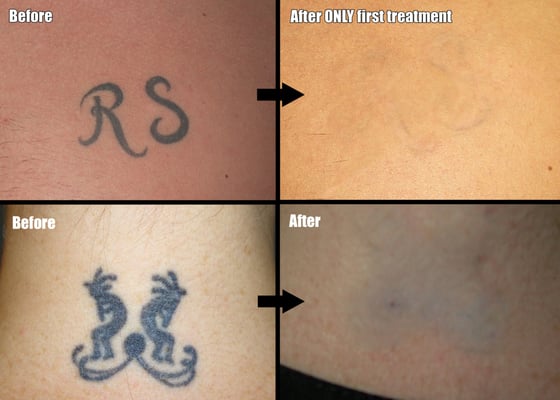 Blank Magic Nonlaser Tattoo Removal  Tattoo Removal  West Allis 
