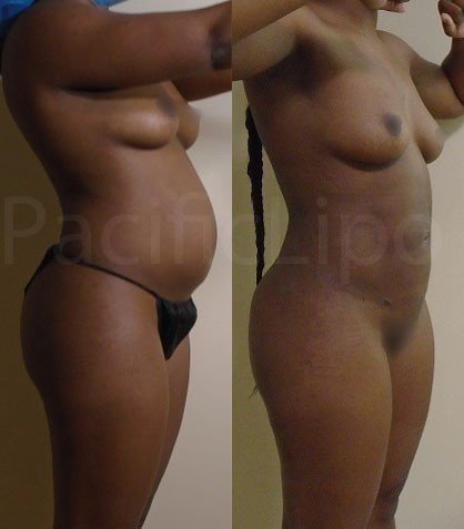 Pacific Lipo
