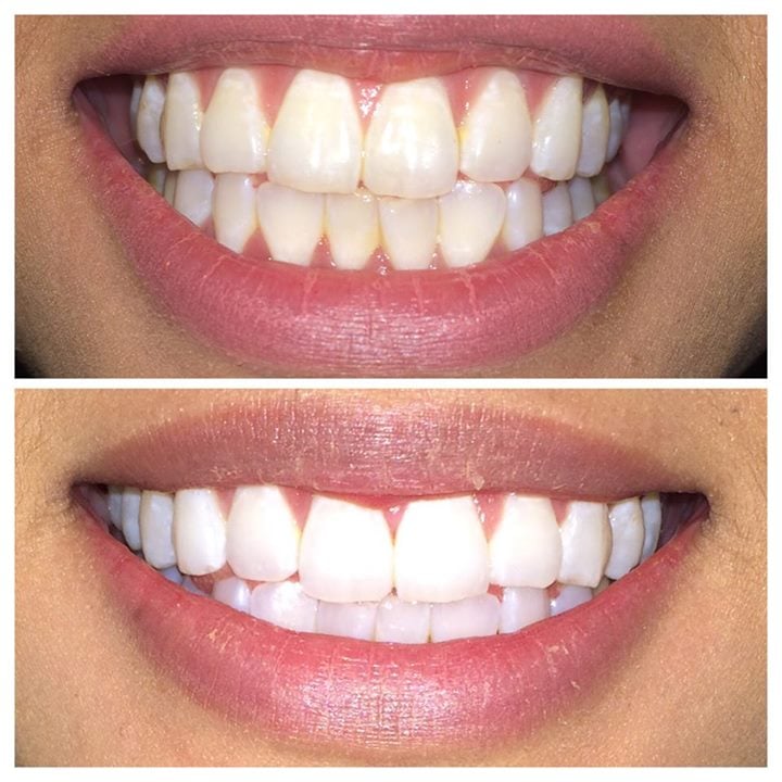Glow Teeth Whitening 17 Photos & 19 Reviews Teeth Whitening 6000