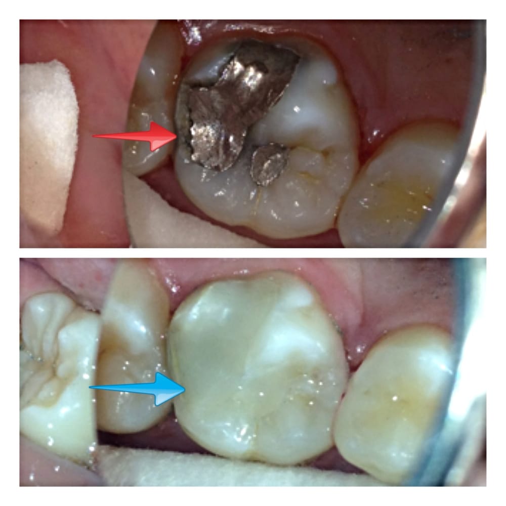 This patient had an extensive cavity under her metal