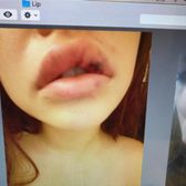 Photo of New Look Skin Center - Encino, CA, United States. My lips a week later still bruised and looks like I was punched.