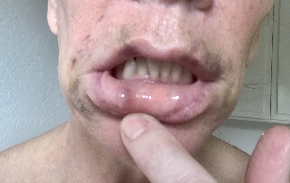 bruised with a swollen bump on the inside of my lip yelp