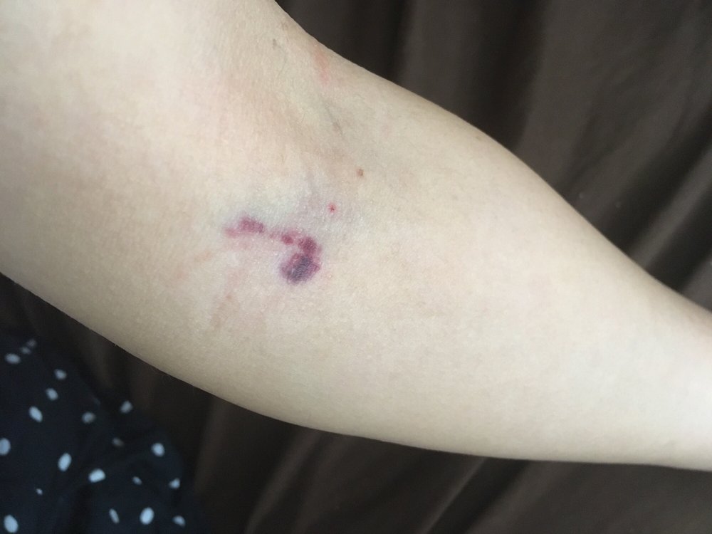 Their bruising blood work. Now my arm is going to be sore Their bruising blood work. Now my arm is going to be sore