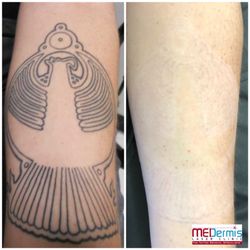 Photo Of Medermis Tattoo Removal San Antonio Tx United States After Photo Of Medermis Tattoo Removal San Antonio Tx United States After