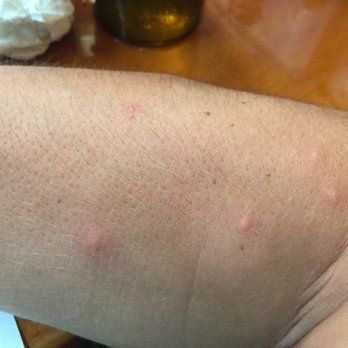 Anchorage Motel 14 Reviews Hotels 51 Mount Desert St Bar Photo Of Anchorage Motel Bar Harbor Me United States Bed Bug Bites