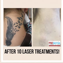 medermis tattoo removal 128 photos u0026 26 reviews tattoo removal medermis tattoo removal 128 photos u0026 26 reviews tattoo removal