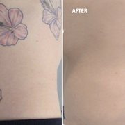 delete tattoo removal boston delete tattoo removal and laser delete tattoo removal boston delete tattoo removal and laser