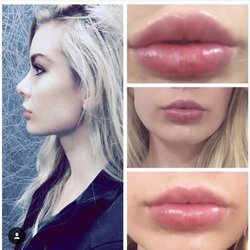 Md Advanced Skincare 46 Photos 16 Reviews Medical Spas 13325 Photo Of Md Advanced Skincare Houston Tx United States Lip Augmentation With