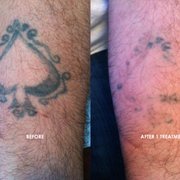 accurate tattoo removal tattoo removal 14401 gilmore st van accurate tattoo removal tattoo removal 14401 gilmore st van