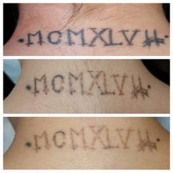 new skin tattoo removal two piercing 302 lark st albany ny new skin tattoo removal two piercing 302 lark st albany ny