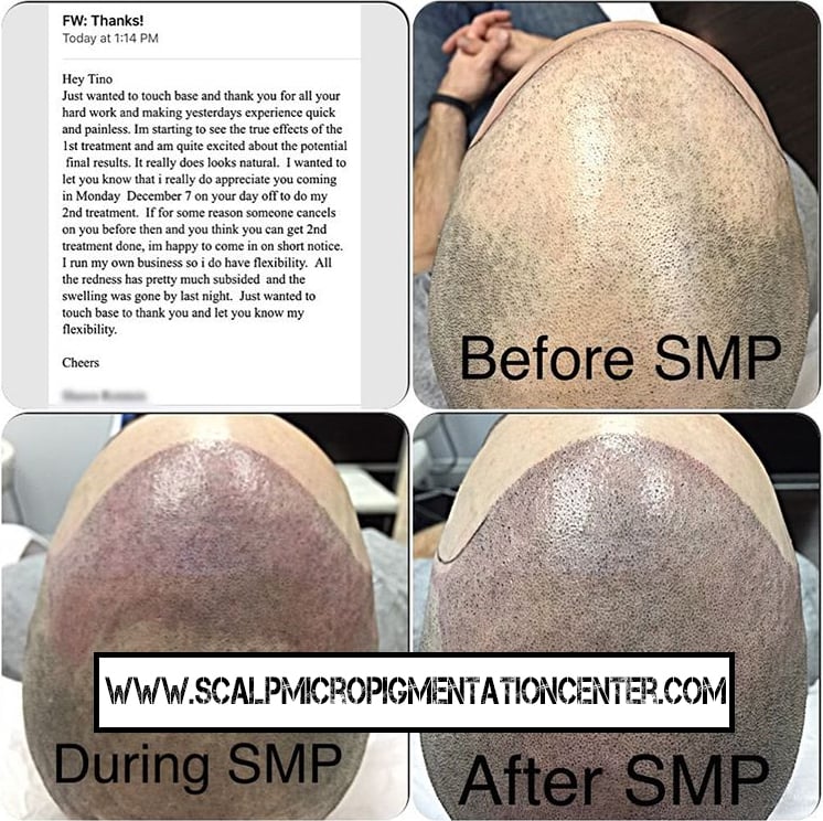 Scalp Micropigmentation Center