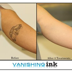 vanishing ink tattoo removal clinic tattoo removal 834 vanishing ink tattoo removal clinic tattoo removal 834