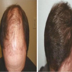 Top 10 Best Hair Club For Men In San Francisco Ca Last Updated