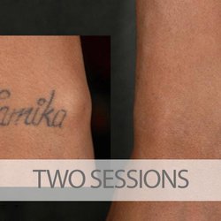 eraditatt tattoo removal orlando 13 photos tattoo removal eraditatt tattoo removal orlando 13 photos tattoo removal