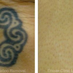 Top 10 Best Fue Hair Transplant In Dallas Tx Last Updated