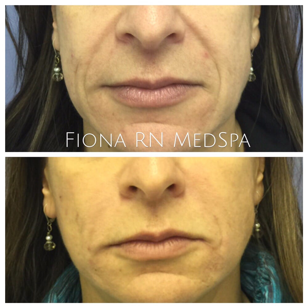 Labial Folds - 1000x1000 - jpeg Labial Folds