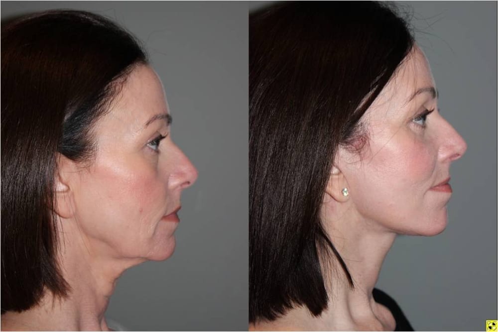 s lift facelift s lift facelift