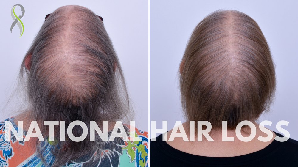 National Hair Loss 16 Photos Hair Loss Centers 1845 W Orange