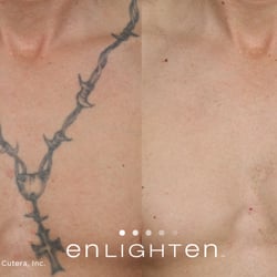 laser skin solutions 17 photos tattoo removal 1300 laser skin solutions 17 photos tattoo removal 1300
