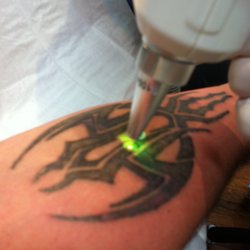 medilase laser tattoo removal specialists 19 photos tattoo medilase laser tattoo removal specialists 19 photos tattoo
