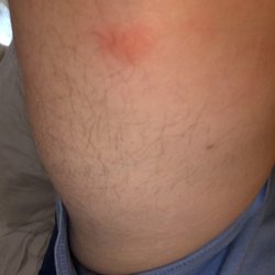 P O Of Vegas Motel Billings Mt United States Bed Bug Bites P O Of Vegas Motel Billings Mt United States Bed Bug Bites