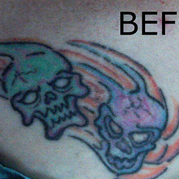 2nd chance tattoo removal tattoo removal 6362 figarden dr 2nd chance tattoo removal tattoo removal 6362 figarden dr