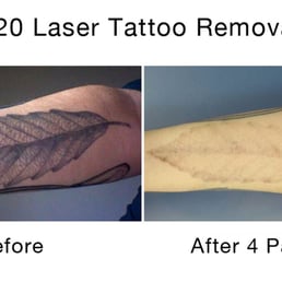 disappearing ink laser tattoo removal tattoo removal 110 e disappearing ink laser tattoo removal tattoo removal 110 e
