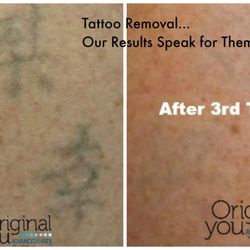 original you advanced laser 17 photos tattoo removal 2420 original you advanced laser 17 photos tattoo removal 2420