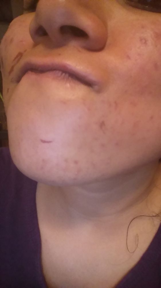 facial waxing burn Facial waxing burn