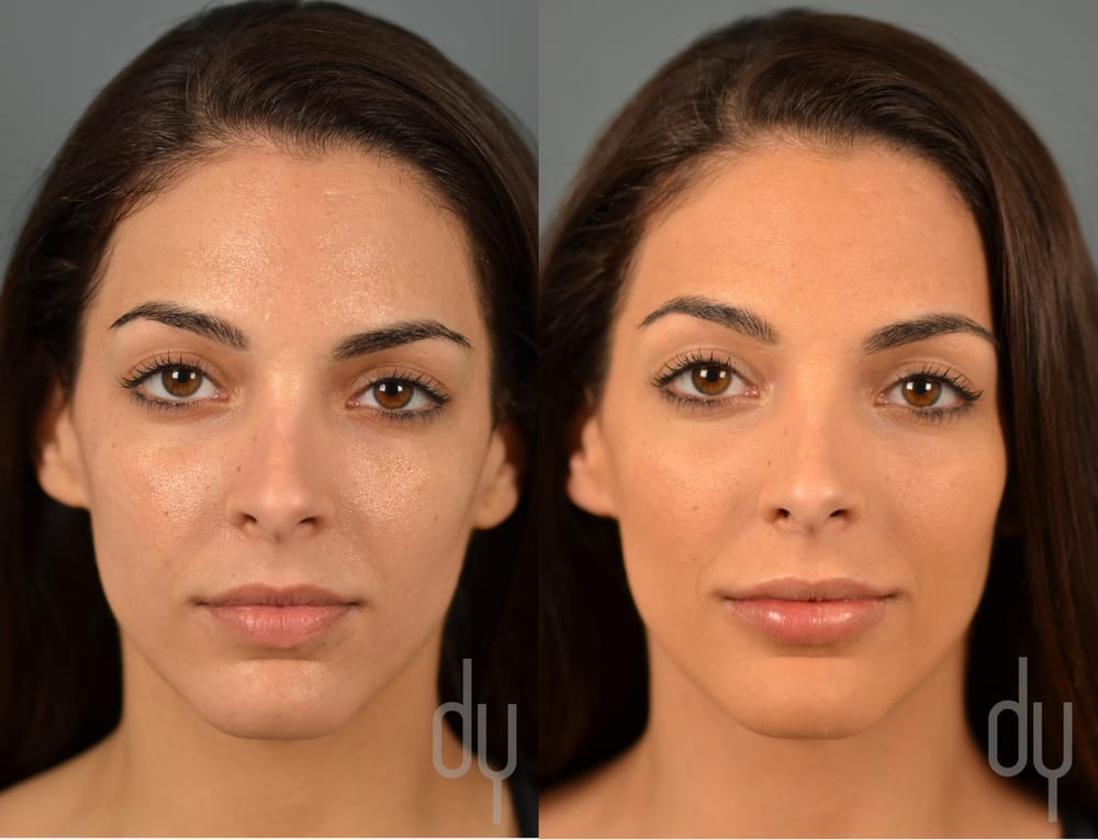 Before and After lip augmentation with Restylane Silk® Juvederm Ultra