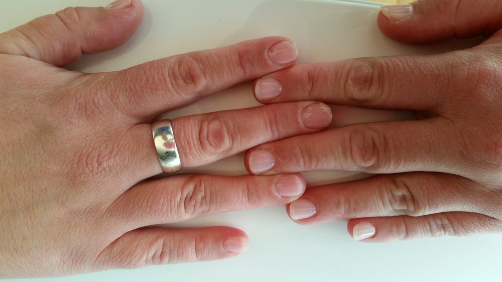 clearly cracked nails on the left index and middle finger the right ring lighter that works