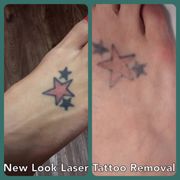 new look laser tattoo removal 11 photos u0026 19 reviews tattoo new look laser tattoo removal 11 photos u0026 19 reviews tattoo