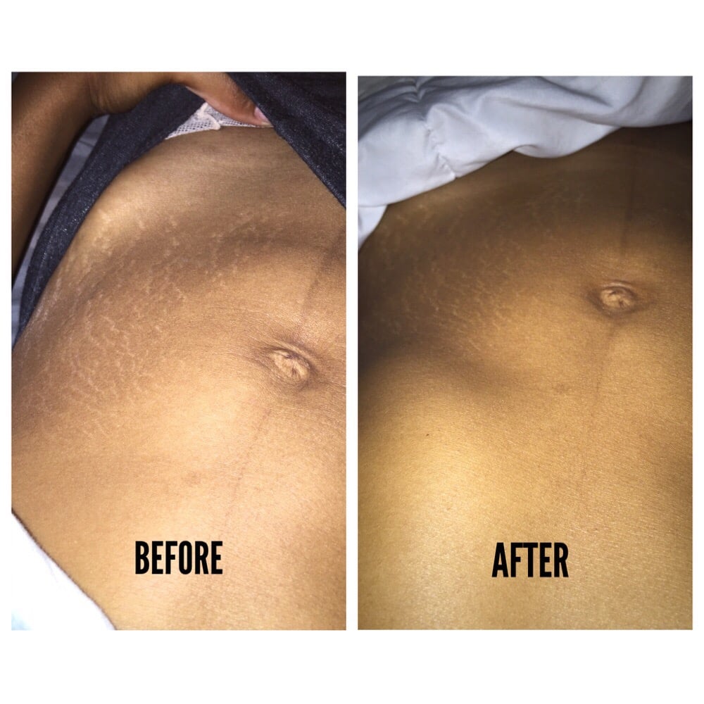 It also reduces the sight of stretch marks!! - Yelp