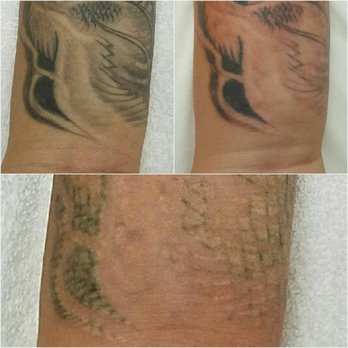 reset tattoo removal 99 photos u0026 58 reviews tattoo removal reset tattoo removal 99 photos u0026 58 reviews tattoo removal