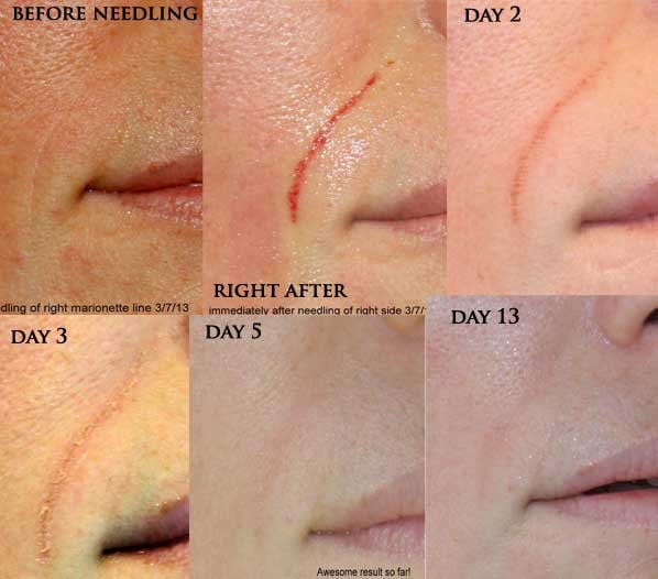 skin needling for wrinkles skin needling for wrinkles
