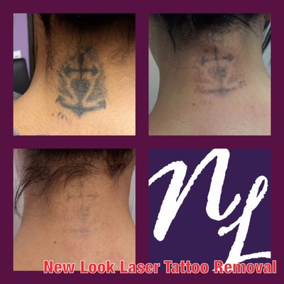 new look laser tattoo removal 19 briar hollow ln suite 115 new look laser tattoo removal 19 briar hollow ln suite 115