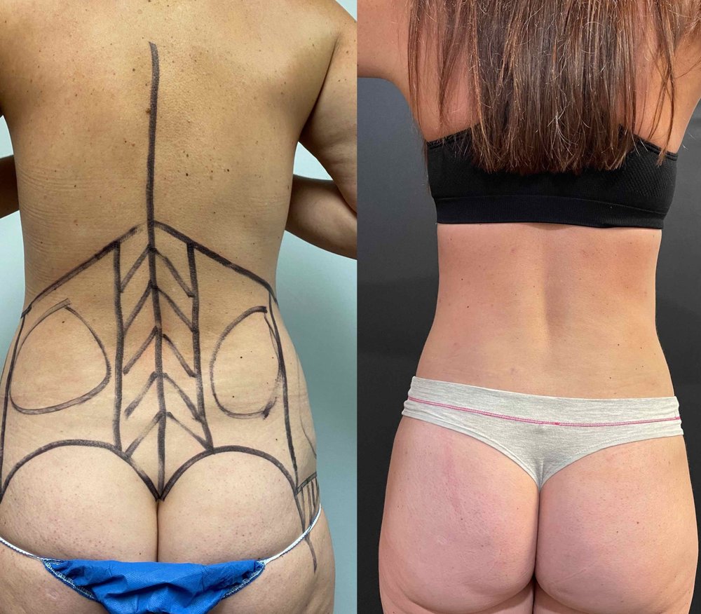 Orange County Liposuction Centers