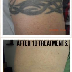 medermis laser tattoo removal 127 photos u0026 27 reviews tattoo medermis laser tattoo removal 127 photos u0026 27 reviews tattoo