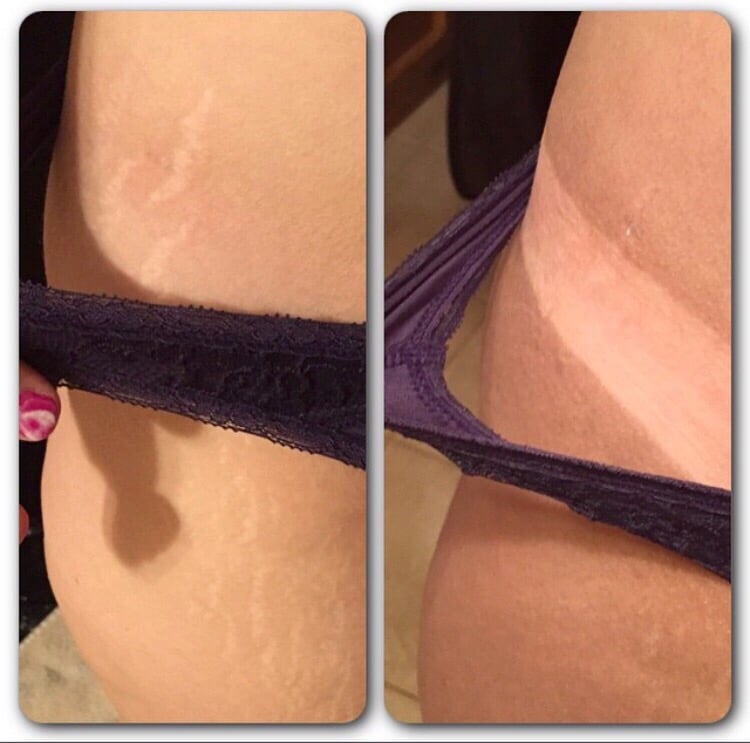does spray cover stretch marks pinterest the world s does spray cover stretch marks pinterest the world s
