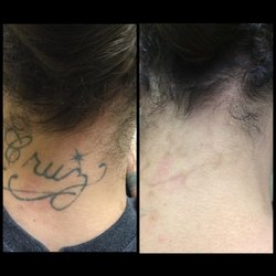 absolute laser tattoo removal 40 photos u0026 15 reviews tattoo absolute laser tattoo removal 40 photos u0026 15 reviews tattoo