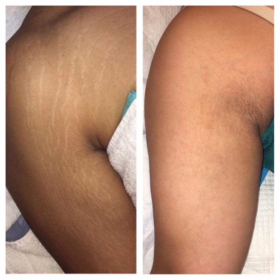 Permanent Makeup Stretch Marks Before And After Saubhaya Makeup