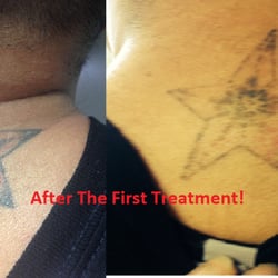 x tattoo 12 photos tattoo removal 5030 s mill ave tempe az x tattoo 12 photos tattoo removal 5030 s mill ave tempe az