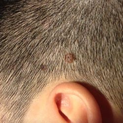 facial mole removal seatle area Facial mole removal seatle area