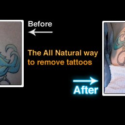 diamond tattoo removal and aesthetics non laser tattoo removal diamond tattoo removal and aesthetics non laser tattoo removal