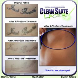 clean slate laser tattoo removal westchester 31 photos u0026 36 clean slate laser tattoo removal westchester 31 photos u0026 36