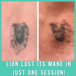 trilogy laser tattoo removal center tattoo removal 5290 trilogy laser tattoo removal center tattoo removal 5290
