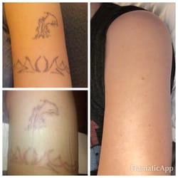 Photo Of Atlantic Laser Tattoo Removal Virginia Beach Va United States Photo Of Atlantic Laser Tattoo Removal Virginia Beach Va United States