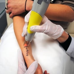 abilene tattoo removal clinic tattoo removal 1290 s willis st abilene tattoo removal clinic tattoo removal 1290 s willis st
