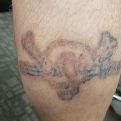 restoration tattoo removal 11 photos tattoo removal 218 251 restoration tattoo removal 11 photos tattoo removal 218 251